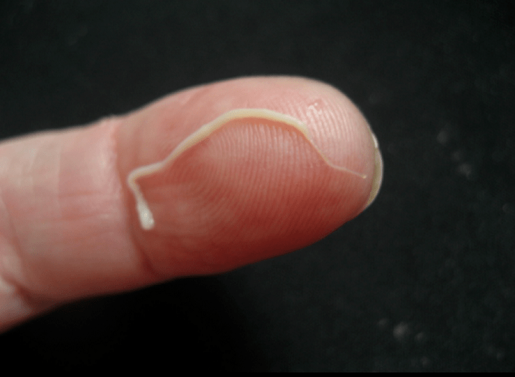 Ronnworm Parasit aus dem mënschleche Kierper